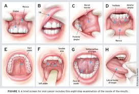 cancer bucal