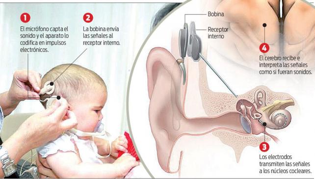 El informe de Nación ante el reclamo puntano por los implantes cocleares y audífonos