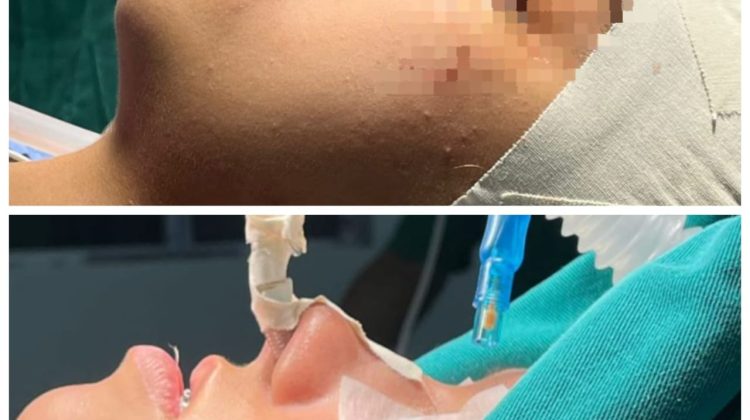 El Hospital Central ‘Dr. Ramón Carrillo’ efectuó la primera cirugía ortognática
