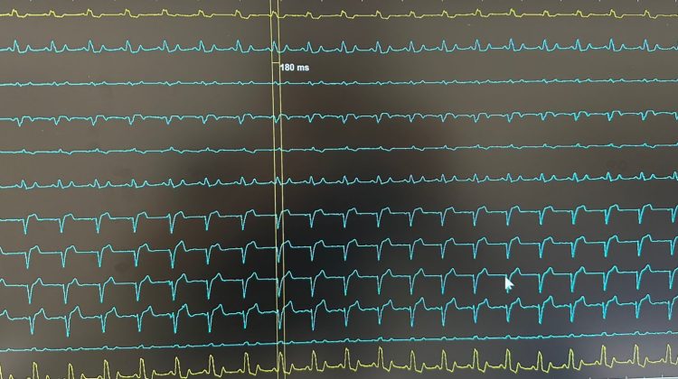 Colocaron por primera vez un marcapasos con estimulación de rama izquierda