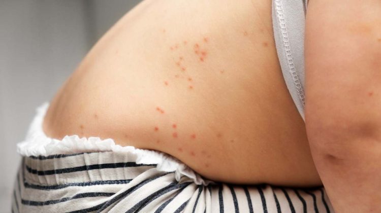 Emiten un alerta epidemiológica por casos de sarampión notificados por la Nación